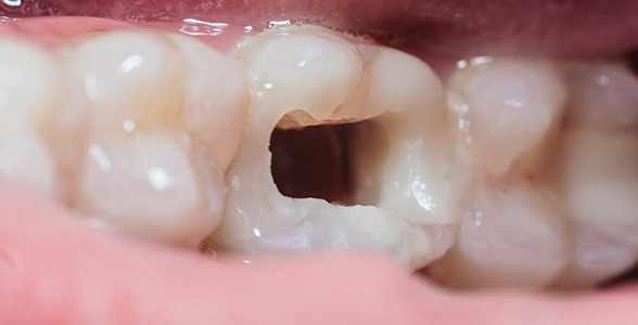 Diferentes tipos de cementos obturadores para endodoncia